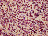 IHC image of CSB-PA010389OA36nhibHU diluted at 1:7 and staining in paraffin-embedded human glioma performed on a Leica BondTM system. After dewaxing and hydration, antigen retrieval was mediated by high pressure in a citrate buffer (pH 6.0) . Section was blocked with 10% normal goat serum 30min at RT. Then primary antibody (1% BSA) was incubated at 4°C overnight. The primary is detected by a biotinylated secondary antibody and visualized using an HRP conjugated SP system.