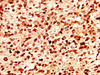 IHC image of CSB-PA010380OA17nphHU diluted at 1:50 and staining in paraffin-embedded human glioma performed on a Leica BondTM system. After dewaxing and hydration, antigen retrieval was mediated by high pressure in a citrate buffer (pH 6.0) . Section was blocked with 10% normal goat serum 30min at RT. Then primary antibody (1% BSA) was incubated at 4°C overnight. The primary is detected by a biotinylated secondary antibody and visualized using an HRP conjugated SP system.