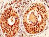 IHC image of CSB-PA010097OA139nphHU diluted at 1:50 and staining in paraffin-embedded human cervical cancer performed on a Leica BondTM system. After dewaxing and hydration, antigen retrieval was mediated by high pressure in a citrate buffer (pH 6.0) . Section was blocked with 10% normal goat serum 30min at RT. Then primary antibody (1% BSA) was incubated at 4°C overnight. The primary is detected by a biotinylated secondary antibody and visualized using an HRP conjugated SP system.