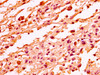 IHC image of CSB-PA010087OA101nme1HU diluted at 1:50 and staining in paraffin-embedded human melanoma performed on a Leica BondTM system. After dewaxing and hydration, antigen retrieval was mediated by high pressure in a citrate buffer (pH 6.0) . Section was blocked with 10% normal goat serum 30min at RT. Then primary antibody (1% BSA) was incubated at 4°C overnight. The primary is detected by a biotinylated secondary antibody and visualized using an HRP conjugated SP system.