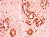 IHC image of CSB-PA010418OA06nphHU diluted at 1:50 and staining in paraffin-embedded human breast cancer performed on a Leica BondTM system. After dewaxing and hydration, antigen retrieval was mediated by high pressure in a citrate buffer (pH 6.0) . Section was blocked with 10% normal goat serum 30min at RT. Then primary antibody (1% BSA) was incubated at 4°C overnight. The primary is detected by a biotinylated secondary antibody and visualized using an HRP conjugated SP system.