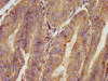 IHC image of CSB-PA001023LA01HU diluted at 1:100 and staining in paraffin-embedded human endometrial cancer performed on a Leica BondTM system. After dewaxing and hydration, antigen retrieval was mediated by high pressure in a citrate buffer (pH 6.0) . Section was blocked with 10% normal goat serum 30min at RT. Then primary antibody (1% BSA) was incubated at 4°C overnight. The primary is detected by a biotinylated secondary antibody and visualized using an HRP conjugated SP system.