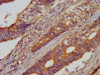 IHC image of CSB-PA001023LA01HU diluted at 1:100 and staining in paraffin-embedded human colon cancer performed on a Leica BondTM system. After dewaxing and hydration, antigen retrieval was mediated by high pressure in a citrate buffer (pH 6.0) . Section was blocked with 10% normal goat serum 30min at RT. Then primary antibody (1% BSA) was incubated at 4°C overnight. The primary is detected by a biotinylated secondary antibody and visualized using an HRP conjugated SP system.