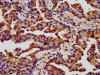 IHC image of CSB-PA005397LA01HU diluted at 1:400 and staining in paraffin-embedded human lung cancer performed on a Leica BondTM system. After dewaxing and hydration, antigen retrieval was mediated by high pressure in a citrate buffer (pH 6.0) . Section was blocked with 10% normal goat serum 30min at RT. Then primary antibody (1% BSA) was incubated at 4°C overnight. The primary is detected by a biotinylated secondary antibody and visualized using an HRP conjugated SP system.