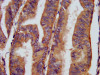 IHC image of CSB-PA005397LA01HU diluted at 1:400 and staining in paraffin-embedded human endometrial cancer performed on a Leica BondTM system. After dewaxing and hydration, antigen retrieval was mediated by high pressure in a citrate buffer (pH 6.0) . Section was blocked with 10% normal goat serum 30min at RT. Then primary antibody (1% BSA) was incubated at 4°C overnight. The primary is detected by a biotinylated secondary antibody and visualized using an HRP conjugated SP system.