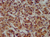 IHC image of CSB-PA006462LA01HU diluted at 1:300 and staining in paraffin-embedded human liver cancer performed on a Leica BondTM system. After dewaxing and hydration, antigen retrieval was mediated by high pressure in a citrate buffer (pH 6.0) . Section was blocked with 10% normal goat serum 30min at RT. Then primary antibody (1% BSA) was incubated at 4°C overnight. The primary is detected by a biotinylated secondary antibody and visualized using an HRP conjugated SP system.