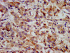 IHC image of CSB-PA010567LA01HU diluted at 1:400 and staining in paraffin-embedded human liver cancer performed on a Leica BondTM system. After dewaxing and hydration, antigen retrieval was mediated by high pressure in a citrate buffer (pH 6.0) . Section was blocked with 10% normal goat serum 30min at RT. Then primary antibody (1% BSA) was incubated at 4°C overnight. The primary is detected by a biotinylated secondary antibody and visualized using an HRP conjugated SP system.