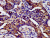 IHC image of CSB-PA010664LA01HU diluted at 1:500 and staining in paraffin-embedded human lung cancer performed on a Leica BondTM system.