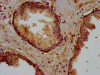 IHC image of CSB-PA012347LA01HU diluted at 1:400 and staining in paraffin-embedded human prostate cancer performed on a Leica BondTM system. After dewaxing and hydration, antigen retrieval was mediated by high pressure in a citrate buffer (pH 6.0) . Section was blocked with 10% normal goat serum 30min at RT. Then primary antibody (1% BSA) was incubated at 4°C overnight. The primary is detected by a biotinylated secondary antibody and visualized using an HRP conjugated SP system.