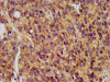 IHC image of CSB-PA013400LA01HU diluted at 1:400 and staining in paraffin-embedded human glioma performed on a Leica BondTM system. After dewaxing and hydration, antigen retrieval was mediated by high pressure in a citrate buffer (pH 6.0) . Section was blocked with 10% normal goat serum 30min at RT. Then primary antibody (1% BSA) was incubated at 4°C overnight. The primary is detected by a biotinylated secondary antibody and visualized using an HRP conjugated SP system.