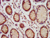 IHC image of CSB-PA013689LA01HU diluted at 1:200 and staining in paraffin-embedded human gastric cancer performed on a Leica BondTM system. After dewaxing and hydration, antigen retrieval was mediated by high pressure in a citrate buffer (pH 6.0) . Section was blocked with 10% normal goat serum 30min at RT. Then primary antibody (1% BSA) was incubated at 4°C overnight. The primary is detected by a biotinylated secondary antibody and visualized using an HRP conjugated SP system.