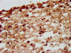 IHC image of CSB-PA015802LA01HU diluted at 1:200 and staining in paraffin-embedded human melanoma performed on a Leica BondTM system.