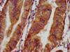 IHC image of CSB-PA015987LA01HU diluted at 1:500 and staining in paraffin-embedded human endometrial cancer performed on a Leica BondTM system. After dewaxing and hydration, antigen retrieval was mediated by high pressure in a citrate buffer (pH 6.0) . Section was blocked with 10% normal goat serum 30min at RT. Then primary antibody (1% BSA) was incubated at 4°C overnight. The primary is detected by a biotinylated secondary antibody and visualized using an HRP conjugated SP system.