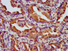 IHC image of CSB-PA015987LA01HU diluted at 1:500 and staining in paraffin-embedded human lung cancer performed on a Leica BondTM system. After dewaxing and hydration, antigen retrieval was mediated by high pressure in a citrate buffer (pH 6.0) . Section was blocked with 10% normal goat serum 30min at RT. Then primary antibody (1% BSA) was incubated at 4°C overnight. The primary is detected by a biotinylated secondary antibody and visualized using an HRP conjugated SP system.