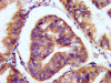 IHC image of CSB-PA017417LA01HU diluted at 1:200 and staining in paraffin-embedded human endometrial cancer performed on a Leica BondTM system. After dewaxing and hydration, antigen retrieval was mediated by high pressure in a citrate buffer (pH 6.0) . Section was blocked with 10% normal goat serum 30min at RT. Then primary antibody (1% BSA) was incubated at 4°C overnight. The primary is detected by a biotinylated secondary antibody and visualized using an HRP conjugated SP system.