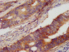 IHC image of CSB-PA017642LA01HU diluted at 1:400 and staining in paraffin-embedded human colon cancer performed on a Leica BondTM system. After dewaxing and hydration, antigen retrieval was mediated by high pressure in a citrate buffer (pH 6.0) . Section was blocked with 10% normal goat serum 30min at RT. Then primary antibody (1% BSA) was incubated at 4°C overnight. The primary is detected by a biotinylated secondary antibody and visualized using an HRP conjugated SP system.