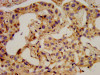 IHC image of CSB-PA017642LA01HU diluted at 1:400 and staining in paraffin-embedded human liver cancer performed on a Leica BondTM system. After dewaxing and hydration, antigen retrieval was mediated by high pressure in a citrate buffer (pH 6.0) . Section was blocked with 10% normal goat serum 30min at RT. Then primary antibody (1% BSA) was incubated at 4°C overnight. The primary is detected by a biotinylated secondary antibody and visualized using an HRP conjugated SP system.