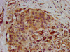 IHC image of CSB-PA019888LA01HU diluted at 1:400 and staining in paraffin-embedded human pancreatic cancer performed on a Leica BondTM system. After dewaxing and hydration, antigen retrieval was mediated by high pressure in a citrate buffer (pH 6.0) . Section was blocked with 10% normal goat serum 30min at RT. Then primary antibody (1% BSA) was incubated at 4°C overnight. The primary is detected by a biotinylated secondary antibody and visualized using an HRP conjugated SP system.