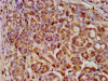 IHC image of CSB-PA021072LA01HU diluted at 1:600 and staining in paraffin-embedded human pancreatic cancer performed on a Leica BondTM system. After dewaxing and hydration, antigen retrieval was mediated by high pressure in a citrate buffer (pH 6.0) . Section was blocked with 10% normal goat serum 30min at RT. Then primary antibody (1% BSA) was incubated at 4°C overnight. The primary is detected by a biotinylated secondary antibody and visualized using an HRP conjugated SP system.