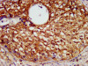 IHC image of CSB-PA021072LA01HU diluted at 1:600 and staining in paraffin-embedded human cervical cancer performed on a Leica BondTM system. After dewaxing and hydration, antigen retrieval was mediated by high pressure in a citrate buffer (pH 6.0) . Section was blocked with 10% normal goat serum 30min at RT. Then primary antibody (1% BSA) was incubated at 4°C overnight. The primary is detected by a biotinylated secondary antibody and visualized using an HRP conjugated SP system.