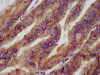 IHC image of CSB-PA021846LA01HU diluted at 1:200 and staining in paraffin-embedded human endometrial cancer performed on a Leica BondTM system. After dewaxing and hydration, antigen retrieval was mediated by high pressure in a citrate buffer (pH 6.0) . Section was blocked with 10% normal goat serum 30min at RT. Then primary antibody (1% BSA) was incubated at 4°C overnight. The primary is detected by a biotinylated secondary antibody and visualized using an HRP conjugated SP system.