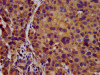 IHC image of CSB-PA613604LA01HU diluted at 1:500 and staining in paraffin-embedded human pancreatic cancer performed on a Leica BondTM system. After dewaxing and hydration, antigen retrieval was mediated by high pressure in a citrate buffer (pH 6.0) . Section was blocked with 10% normal goat serum 30min at RT. Then primary antibody (1% BSA) was incubated at 4°C overnight. The primary is detected by a biotinylated secondary antibody and visualized using an HRP conjugated SP system.