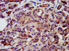 IHC image of CSB-PA614883LA01HU diluted at 1:200 and staining in paraffin-embedded human pancreatic cancer performed on a Leica BondTM system. After dewaxing and hydration, antigen retrieval was mediated by high pressure in a citrate buffer (pH 6.0) . Section was blocked with 10% normal goat serum 30min at RT. Then primary antibody (1% BSA) was incubated at 4°C overnight. The primary is detected by a biotinylated secondary antibody and visualized using an HRP conjugated SP system.