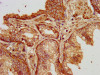 IHC image of CSB-PA615678LA01HU diluted at 1:200 and staining in paraffin-embedded human prostate cancer performed on a Leica BondTM system. After dewaxing and hydration, antigen retrieval was mediated by high pressure in a citrate buffer (pH 6.0) . Section was blocked with 10% normal goat serum 30min at RT. Then primary antibody (1% BSA) was incubated at 4°C overnight. The primary is detected by a biotinylated secondary antibody and visualized using an HRP conjugated SP system. IHC image of CSB-PA615678LA01HU diluted at 1:200 and staining in paraffin-embedded human prostate cancer performed on a Leica BondTM system. After dewaxing and hydration, antigen retrieval was mediated by high pressure in a citrate buffer (pH 6.0) . Section was blocked with 10% normal goat serum 30min at RT. Then primary antibody (1% BSA) was incubated at 4°C overnight. The primary is detected by a biotinylated secondary antibody and visualized using an HRP conjugated SP system.