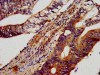 IHC image of CSB-PA652403LA01HU diluted at 1:600 and staining in paraffin-embedded human colon cancer performed on a Leica BondTM system. After dewaxing and hydration, antigen retrieval was mediated by high pressure in a citrate buffer (pH 6.0) . Section was blocked with 10% normal goat serum 30min at RT. Then primary antibody (1% BSA) was incubated at 4°C overnight. The primary is detected by a biotinylated secondary antibody and visualized using an HRP conjugated SP system.