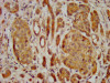 IHC image of CSB-PA722558LA01HU diluted at 1:400 and staining in paraffin-embedded human pancreatic cancer performed on a Leica BondTM system. After dewaxing and hydration, antigen retrieval was mediated by high pressure in a citrate buffer (pH 6.0) . Section was blocked with 10% normal goat serum 30min at RT. Then primary antibody (1% BSA) was incubated at 4°C overnight. The primary is detected by a biotinylated secondary antibody and visualized using an HRP conjugated SP system.