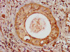 IHC image of CSB-PA728898LA01HU diluted at 1:100 and staining in paraffin-embedded human cervical cancer performed on a Leica BondTM system. After dewaxing and hydration, antigen retrieval was mediated by high pressure in a citrate buffer (pH 6.0) . Section was blocked with 10% normal goat serum 30min at RT. Then primary antibody (1% BSA) was incubated at 4°C overnight. The primary is detected by a biotinylated secondary antibody and visualized using an HRP conjugated SP system.