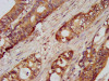 IHC image of CSB-PA728898LA01HU diluted at 1:100 and staining in paraffin-embedded human colon cancer performed on a Leica BondTM system. After dewaxing and hydration, antigen retrieval was mediated by high pressure in a citrate buffer (pH 6.0) . Section was blocked with 10% normal goat serum 30min at RT. Then primary antibody (1% BSA) was incubated at 4°C overnight. The primary is detected by a biotinylated secondary antibody and visualized using an HRP conjugated SP system.