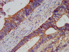 IHC image of CSB-PA801223LA01HU diluted at 1:200 and staining in paraffin-embedded human colon cancer performed on a Leica BondTM system. After dewaxing and hydration, antigen retrieval was mediated by high pressure in a citrate buffer (pH 6.0) . Section was blocked with 10% normal goat serum 30min at RT. Then primary antibody (1% BSA) was incubated at 4°C overnight. The primary is detected by a biotinylated secondary antibody and visualized using an HRP conjugated SP system.