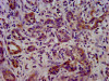 IHC image of CSB-PA801252LA01HU diluted at 1:400 and staining in paraffin-embedded human pancreatic cancer performed on a Leica BondTM system. After dewaxing and hydration, antigen retrieval was mediated by high pressure in a citrate buffer (pH 6.0) . Section was blocked with 10% normal goat serum 30min at RT. Then primary antibody (1% BSA) was incubated at 4°C overnight. The primary is detected by a biotinylated secondary antibody and visualized using an HRP conjugated SP system.