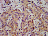 IHC image of CSB-PA804482LA01HU diluted at 1:500 and staining in paraffin-embedded human liver cancer performed on a Leica BondTM system. After dewaxing and hydration, antigen retrieval was mediated by high pressure in a citrate buffer (pH 6.0) . Section was blocked with 10% normal goat serum 30min at RT. Then primary antibody (1% BSA) was incubated at 4°C overnight. The primary is detected by a biotinylated secondary antibody and visualized using an HRP conjugated SP system.