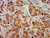 IHC image of CSB-PA892492LA01HU diluted at 1:400 and staining in paraffin-embedded human liver cancer performed on a Leica BondTM system. After dewaxing and hydration, antigen retrieval was mediated by high pressure in a citrate buffer (pH 6.0) . Section was blocked with 10% normal goat serum 30min at RT. Then primary antibody (1% BSA) was incubated at 4°C overnight. The primary is detected by a biotinylated secondary antibody and visualized using an HRP conjugated SP system.