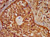 IHC image of CSB-PA010418OA18nforHU diluted at 1:30 and staining in paraffin-embedded human colon cancer performed on a Leica BondTM system. After dewaxing and hydration, antigen retrieval was mediated by high pressure in a citrate buffer (pH 6.0) . Section was blocked with 10% normal goat serum 30min at RT. Then primary antibody (1% BSA) was incubated at 4°C overnight. The primary is detected by a biotinylated secondary antibody and visualized using an HRP conjugated SP system.