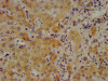 IHC image of CSB-PA003949LA01HU diluted at 1:700 and staining in paraffin-embedded human liver cancer performed on a Leica BondTM system. After dewaxing and hydration, antigen retrieval was mediated by high pressure in a citrate buffer (pH 6.0) . Section was blocked with 10% normal goat serum 30min at RT. Then primary antibody (1% BSA) was incubated at 4°C overnight. The primary is detected by a biotinylated secondary antibody and visualized using an HRP conjugated SP system.