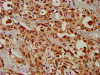 IHC image of CSB-PA005913LA01HU diluted at 1:300 and staining in paraffin-embedded human liver cancer performed on a Leica BondTM system. After dewaxing and hydration, antigen retrieval was mediated by high pressure in a citrate buffer (pH 6.0) . Section was blocked with 10% normal goat serum 30min at RT. Then primary antibody (1% BSA) was incubated at 4°C overnight. The primary is detected by a biotinylated secondary antibody and visualized using an HRP conjugated SP system.