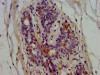 IHC image of CSB-PA007747LA01HU diluted at 1:600 and staining in paraffin-embedded human breast cancer performed on a Leica BondTM system. After dewaxing and hydration, antigen retrieval was mediated by high pressure in a citrate buffer (pH 6.0) . Section was blocked with 10% normal goat serum 30min at RT. Then primary antibody (1% BSA) was incubated at 4°C overnight. The primary is detected by a biotinylated secondary antibody and visualized using an HRP conjugated SP system.