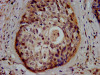 IHC image of CSB-PA009969LA01HU diluted at 1:500 and staining in paraffin-embedded human cervical cancer performed on a Leica BondTM system. After dewaxing and hydration, antigen retrieval was mediated by high pressure in a citrate buffer (pH 6.0) . Section was blocked with 10% normal goat serum 30min at RT. Then primary antibody (1% BSA) was incubated at 4°C overnight. The primary is detected by a biotinylated secondary antibody and visualized using an HRP conjugated SP system.