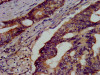 IHC image of CSB-PA009969LA01HU diluted at 1:500 and staining in paraffin-embedded human colon cancer performed on a Leica BondTM system. After dewaxing and hydration, antigen retrieval was mediated by high pressure in a citrate buffer (pH 6.0) . Section was blocked with 10% normal goat serum 30min at RT. Then primary antibody (1% BSA) was incubated at 4°C overnight. The primary is detected by a biotinylated secondary antibody and visualized using an HRP conjugated SP system.