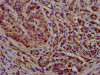 IHC image of CSB-PA017523LA01HU diluted at 1:300 and staining in paraffin-embedded human pancreatic cancer performed on a Leica BondTM system. After dewaxing and hydration, antigen retrieval was mediated by high pressure in a citrate buffer (pH 6.0) . Section was blocked with 10% normal goat serum 30min at RT. Then primary antibody (1% BSA) was incubated at 4°C overnight. The primary is detected by a biotinylated secondary antibody and visualized using an HRP conjugated SP system.