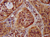 IHC image of CSB-PA612121LA01HU diluted at 1:300 and staining in paraffin-embedded human cervical cancer performed on a Leica BondTM system. After dewaxing and hydration, antigen retrieval was mediated by high pressure in a citrate buffer (pH 6.0) . Section was blocked with 10% normal goat serum 30min at RT. Then primary antibody (1% BSA) was incubated at 4°C overnight. The primary is detected by a biotinylated secondary antibody and visualized using an HRP conjugated SP system.