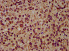 IHC image of CSB-PA618638EA01HU diluted at 1:200 and staining in paraffin-embedded human glioma performed on a Leica BondTM system. After dewaxing and hydration, antigen retrieval was mediated by high pressure in a citrate buffer (pH 6.0) . Section was blocked with 10% normal goat serum 30min at RT. Then primary antibody (1% BSA) was incubated at 4°C overnight. The primary is detected by a biotinylated secondary antibody and visualized using an HRP conjugated SP system. IHC image of CSB-PA618638EA01HU diluted at 1:200 and staining in paraffin-embedded human glioma performed on a Leica BondTM system. After dewaxing and hydration, antigen retrieval was mediated by high pressure in a citrate buffer (pH 6.0) . Section was blocked with 10% normal goat serum 30min at RT. Then primary antibody (1% BSA) was incubated at 4°C overnight. The primary is detected by a biotinylated secondary antibody and visualized using an HRP conjugated SP system.