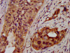 IHC image of CSB-PA618994LA01HU diluted at 1:400 and staining in paraffin-embedded human cervical cancer performed on a Leica BondTM system. After dewaxing and hydration, antigen retrieval was mediated by high pressure in a citrate buffer (pH 6.0) . Section was blocked with 10% normal goat serum 30min at RT. Then primary antibody (1% BSA) was incubated at 4°C overnight. The primary is detected by a biotinylated secondary antibody and visualized using an HRP conjugated SP system.