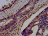 IHC image of CSB-PA773793LA01HU diluted at 1:300 and staining in paraffin-embedded human colon cancer performed on a Leica BondTM system. After dewaxing and hydration, antigen retrieval was mediated by high pressure in a citrate buffer (pH 6.0) . Section was blocked with 10% normal goat serum 30min at RT. Then primary antibody (1% BSA) was incubated at 4°C overnight. The primary is detected by a biotinylated secondary antibody and visualized using an HRP conjugated SP system.