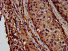 IHC image of CSB-PA774814LA01HU diluted at 1:600 and staining in paraffin-embedded human lung cancer performed on a Leica BondTM system. After dewaxing and hydration, antigen retrieval was mediated by high pressure in a citrate buffer (pH 6.0) . Section was blocked with 10% normal goat serum 30min at RT. Then primary antibody (1% BSA) was incubated at 4°C overnight. The primary is detected by a biotinylated secondary antibody and visualized using an HRP conjugated SP system.