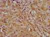 IHC image of CSB-PA774814LA01HU diluted at 1:600 and staining in paraffin-embedded human liver cancer performed on a Leica BondTM system. After dewaxing and hydration, antigen retrieval was mediated by high pressure in a citrate buffer (pH 6.0) . Section was blocked with 10% normal goat serum 30min at RT. Then primary antibody (1% BSA) was incubated at 4°C overnight. The primary is detected by a biotinylated secondary antibody and visualized using an HRP conjugated SP system.