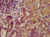 IHC image of CSB-PA818678LA01HU diluted at 1:200 and staining in paraffin-embedded human liver cancer performed on a Leica BondTM system. After dewaxing and hydration, antigen retrieval was mediated by high pressure in a citrate buffer (pH 6.0) . Section was blocked with 10% normal goat serum 30min at RT. Then primary antibody (1% BSA) was incubated at 4°C overnight. The primary is detected by a biotinylated secondary antibody and visualized using an HRP conjugated SP system.